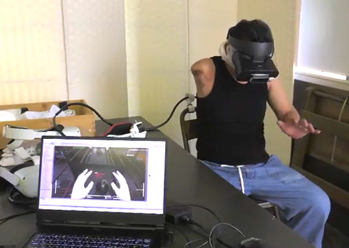 幻肢痛向けVRアプリ「Mirror-VR(ミラーVR)」使用